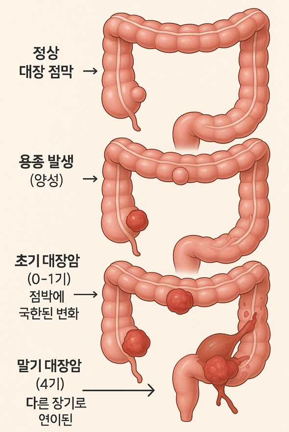 대장암 증상 점막 용종 초기대장암 말기대장암 이미지